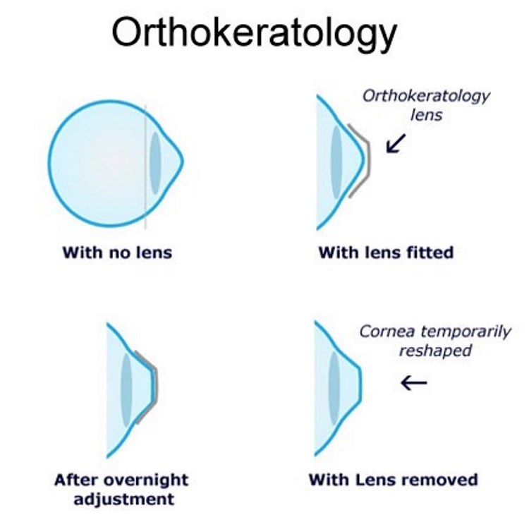 Orthokeratology